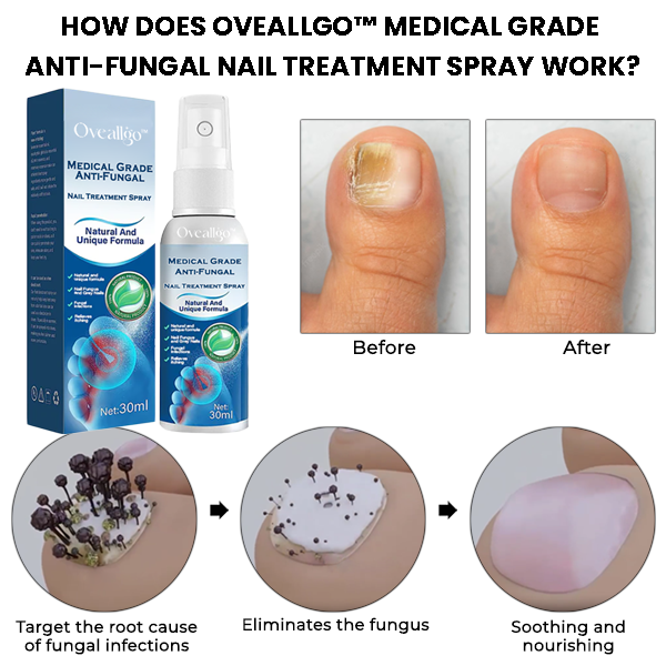 Oveallgo™ Anti-Pilz-Nagelbehandlungsspray in medizinischer Qualität