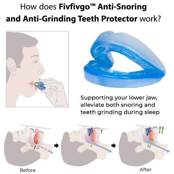 Oveallgo™ Zahnschutz gegen Schnarchen und Knirschen