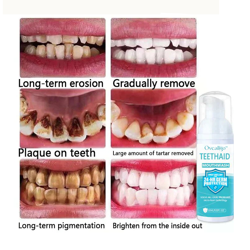 ✨Von Zahnärzten empfohlen 🦷 Oveallgo™ ProX Intensive Fleckenentfernung Mundreinigungsschaum