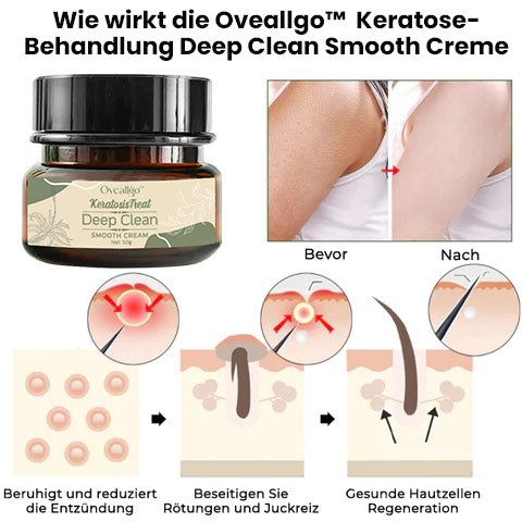 Oveallgo™ Keratose-Behandlung Deep Clean Smooth Creme