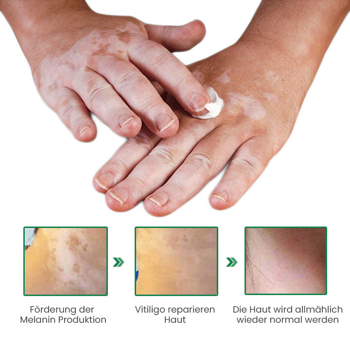 Oveallgo™ PRO VitiligoFix Revitalisierendes Elixier