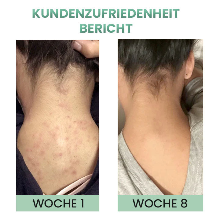 German DerMistPRO Rücken Akne Behandlung Kräuterspray
