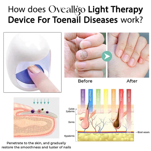 Oveallgo™ Lichttherapiegerät für Zehennagelerkrankungen