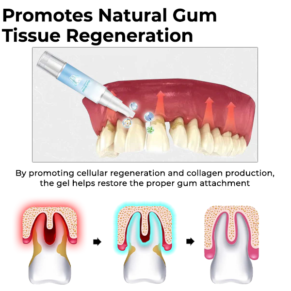 Oveallgo™ Gum Shield-therapiegel