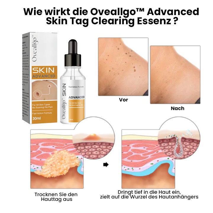 Oveallgo™ Advanced Ultimativ Skin Tag Clearing Essenz