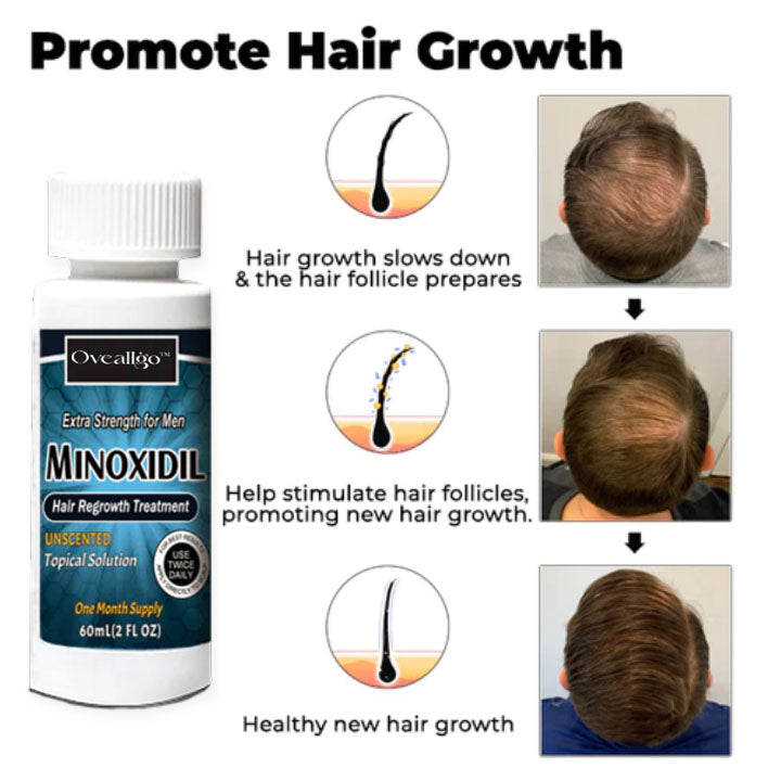 Oveallgo™ Minoxidil Haarwuchsmittel